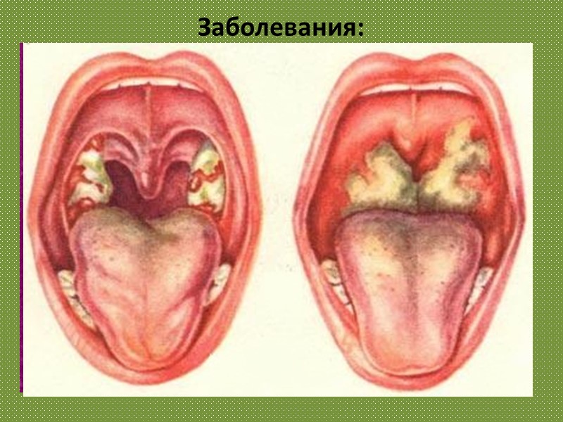 Заболевания: . Дифтерия – инфекционное заболевание, вызываемое дифтерийной палочкой, чаще всего поражает ротоглотку, но